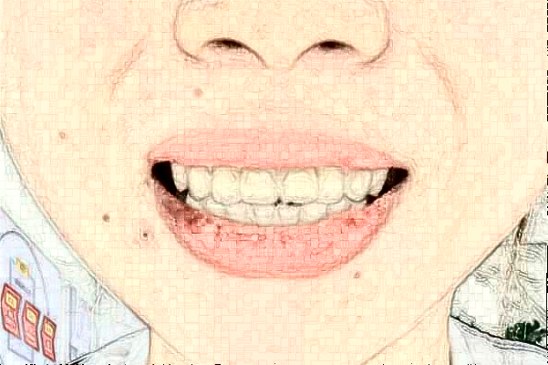 常州市第一人民醫(yī)院拔智齒需要多少錢_案例分享