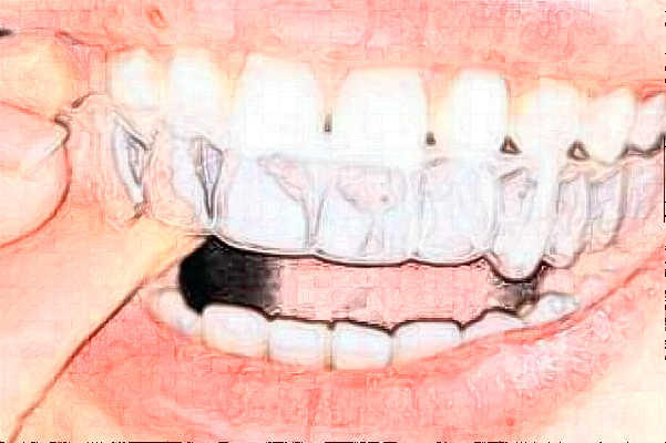 	 重慶醫(yī)科大學(xué)附屬口腔醫(yī)院隱形牙套矯正手術(shù)做的好嗎_誰做的比較好