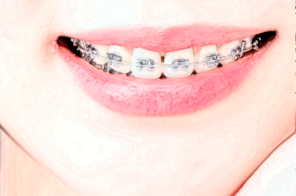 重慶醫(yī)科大學(xué)附屬口腔醫(yī)院做牙齒矯正價(jià)目表(價(jià)格表)怎么樣