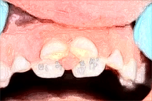 昆明總醫(yī)院牙科怎么樣?2024牙科項目收費價格