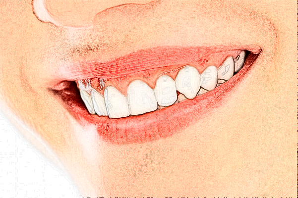 合肥市第二人民醫(yī)院牙套一般多少錢(qián)?牙套有哪幾種類(lèi)型