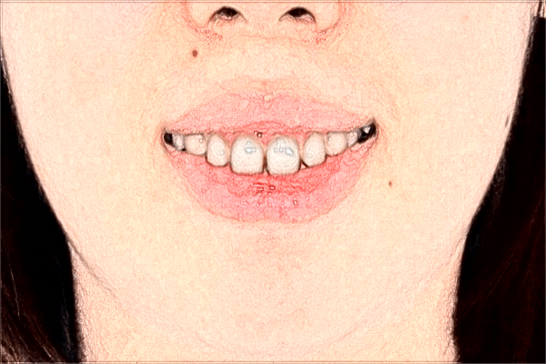 2024江西省口腔醫(yī)院種植牙收費(fèi)標(biāo)準(zhǔn)?種植牙有什么風(fēng)險(xiǎn)