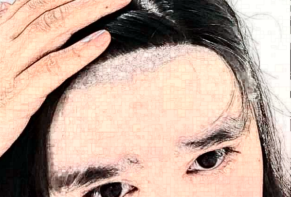 2024阜陽(yáng)市人民醫(yī)院植發(fā)際線做的好嗎_需要多少錢