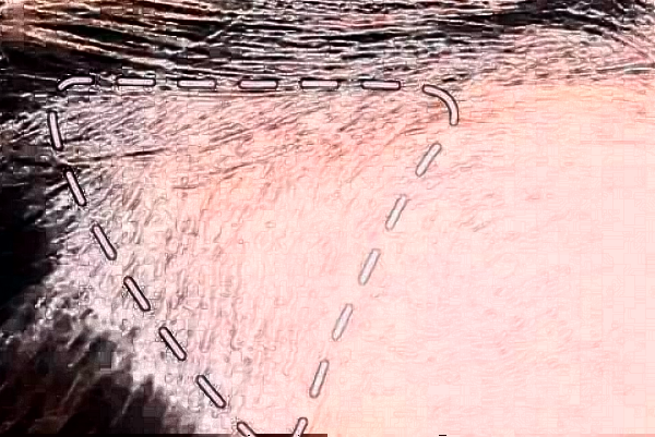 2024阜陽(yáng)市人民醫(yī)院植發(fā)際線做的好嗎_需要多少錢