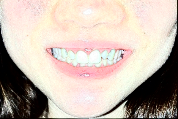 2024金華市中心醫(yī)院口腔科郭婷婷醫(yī)生技術(shù)怎么樣