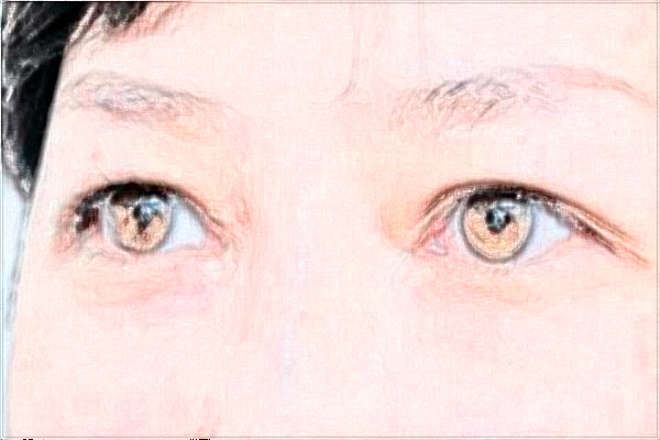 2024金華市中心醫(yī)院激光近視誰做的好?激光近視手術(shù)的后遺癥有哪些