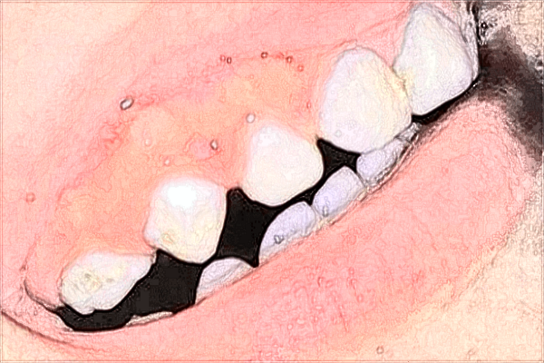 南寧303醫(yī)院牙科好不好?2024牙齒矯正費用怎么樣
