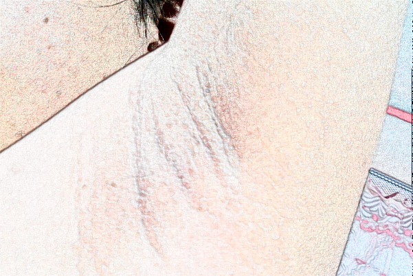 徐州市中心醫(yī)院去狐臭怎么樣_價格+案例分享