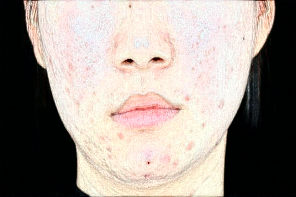 哈爾濱醫(yī)科大學(xué)附屬第一醫(yī)院去疤做的好嗎_案例+價(jià)格