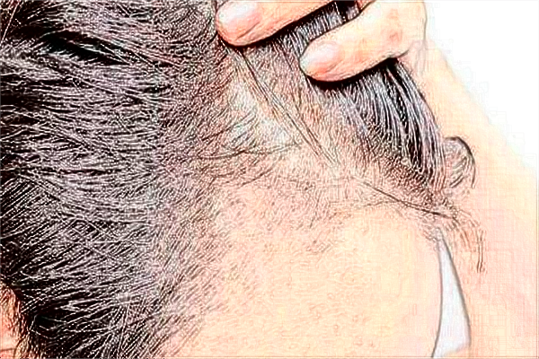 中山大學附屬第一醫(yī)院植發(fā)怎么樣?2024植發(fā)價格