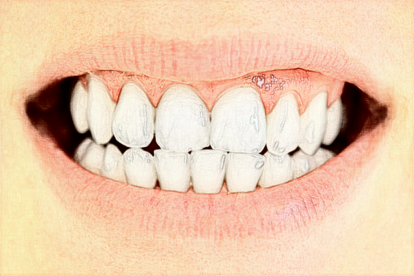 中山大學(xué)附屬口腔醫(yī)院種牙怎么樣?種牙和鑲牙的區(qū)別