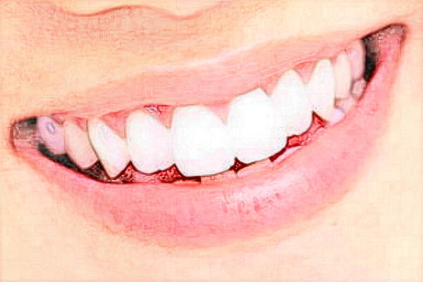 中山大學(xué)附屬口腔醫(yī)院種牙怎么樣?種牙和鑲牙的區(qū)別