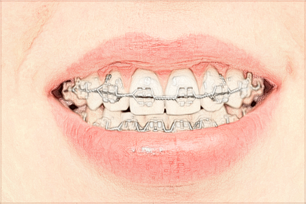 2024珠海市人民醫(yī)院矯正牙齒多少錢?矯正牙齒好嗎