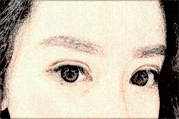 中山市人民醫(yī)院去川字紋去哪科?2024去川字紋多少錢(qián)