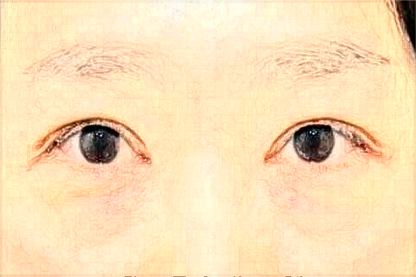 2024徐州市中心醫(yī)院激光消除黑眼圈做的好嗎？體驗(yàn)案例分享