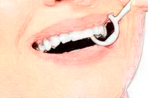 天津市口腔醫(yī)院瓷貼面價目表(價格表)怎么樣