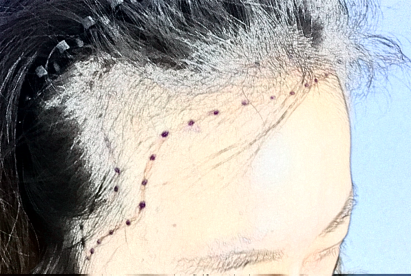 2024臺(tái)州醫(yī)院植發(fā)怎么樣_哪位醫(yī)生技術(shù)比較不錯(cuò) 