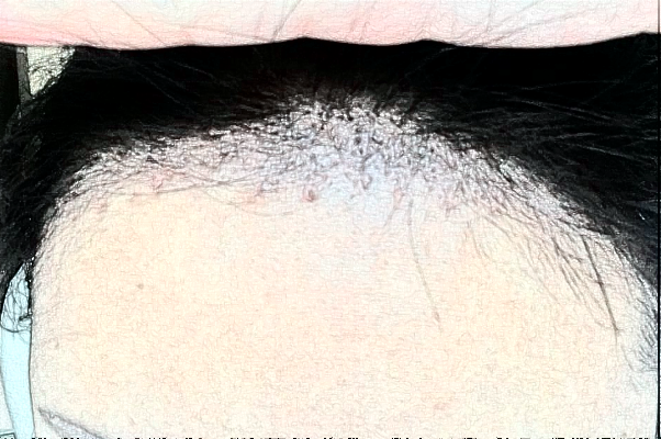 2024臺(tái)州醫(yī)院植發(fā)怎么樣_哪位醫(yī)生技術(shù)比較不錯(cuò) 