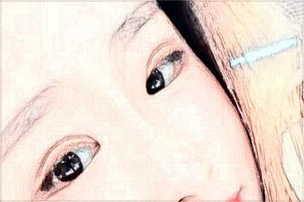 蘇州第四人民醫(yī)院激光去紅血絲多少費(fèi)用？醫(yī)生排名