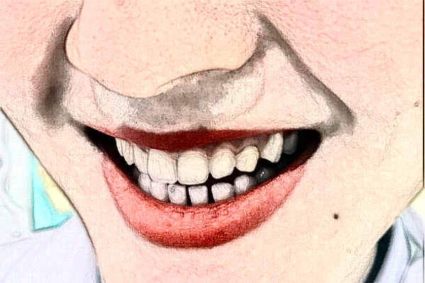 2024南京鼓樓醫(yī)院牙齒貼面多少錢?醫(yī)生名單推薦