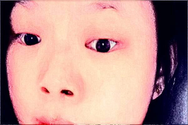 2024南京中大醫(yī)院激光除皺做的怎么樣【整形案例分享】