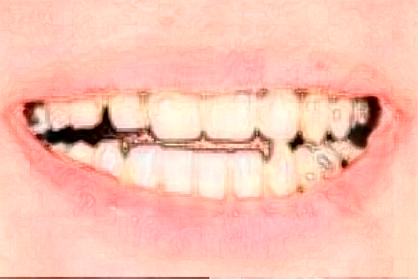 常州市第三人民醫(yī)院口腔科拔牙怎么樣_拔牙會(huì)影響其他牙齒松動(dòng)嗎