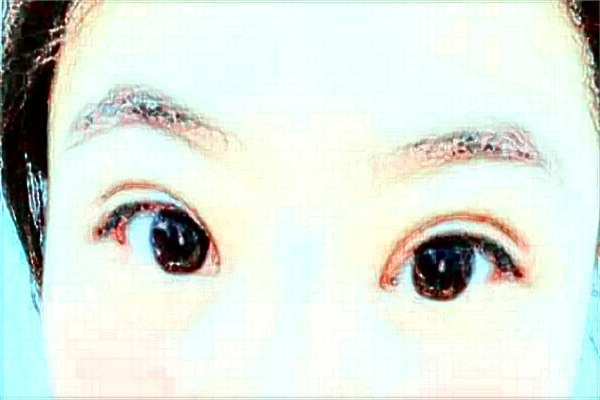 杭州市第一人民醫(yī)院近視激光手術(shù)做的怎么樣？醫(yī)生推薦