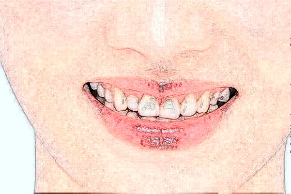 天津醫(yī)科大學(xué)第二醫(yī)院口腔科拔智齒大概多少錢?實測案例分享