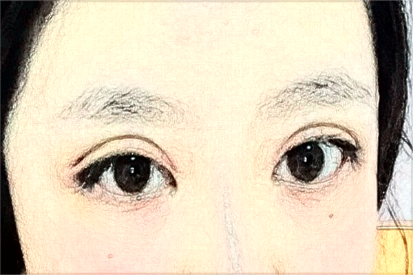 溫州醫(yī)學院附屬第一醫(yī)院做雙眼皮怎么樣_大概需要多少錢