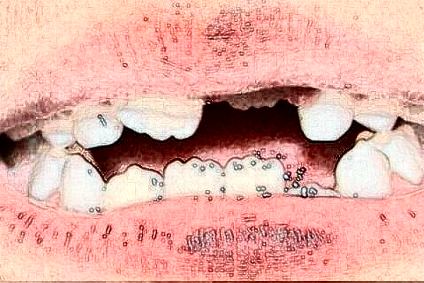 大連大學(xué)附屬中山醫(yī)院口腔科牙齒修復(fù)做的怎么樣【案例分享】