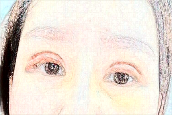 2024合肥市第一人民醫(yī)院割雙眼皮做的好嗎_哪位醫(yī)生做的好