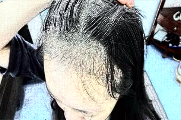 2024南京中大醫(yī)院植發(fā)做的怎么樣_誰做的比較好