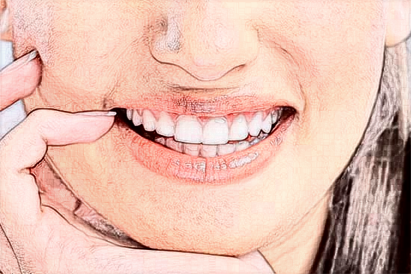 2024中山大學(xué)附屬口腔醫(yī)院瓷貼面費用?瓷貼面能保持多久