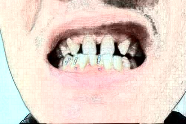 2024天津醫(yī)科大學(xué)第二醫(yī)院口腔科補(bǔ)牙大概多少錢(qián)?實(shí)測(cè)案例分享