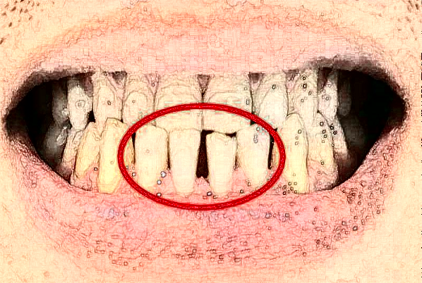 2024天津醫(yī)科大學(xué)第二醫(yī)院口腔科補(bǔ)牙大概多少錢(qián)?實(shí)測(cè)案例分享