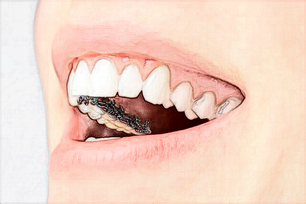 中山大學(xué)附屬口腔醫(yī)院種植牙王勁茗好嗎?種植牙王勁茗怎么樣?