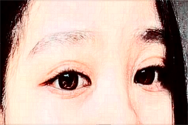 2024安徽省立醫(yī)院全飛秒激光多少錢？誰(shuí)做得好