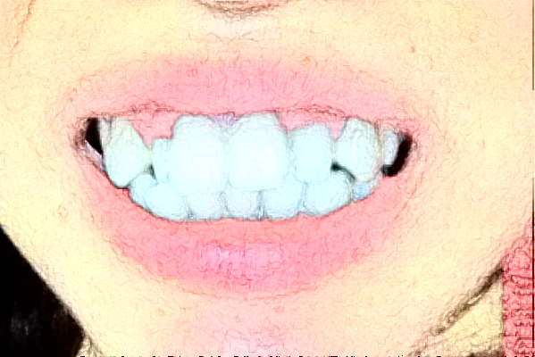 太原市中心醫(yī)院口腔科種植牙價格嘗鮮版_體驗(yàn)日記分享