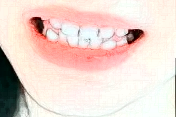 大連大學(xué)附屬中山醫(yī)院口腔科拔牙做的好嗎_拔牙整形日記