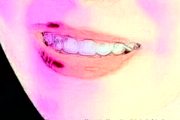 大連大學(xué)附屬中山醫(yī)院口腔科拔牙做的好嗎_拔牙整形日記