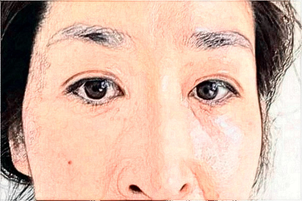 2024南京鼓樓醫(yī)院去眼袋怎么樣_體驗(yàn)日記分享