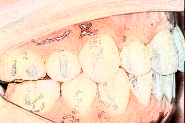 南通大學(xué)附屬醫(yī)院隱形正畸做的好嗎？誰做的好