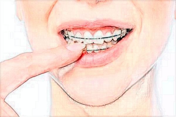 2024中山大學(xué)附屬第五醫(yī)院牙齒美白好嗎?牙齒美白價格