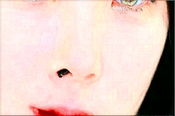 2024天津醫(yī)科大學(xué)總醫(yī)院可以去胎記嗎？去胎記真實案例