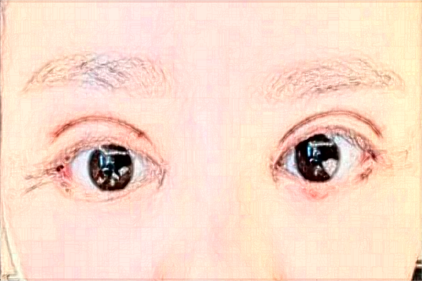 天津醫(yī)科大學(xué)總醫(yī)院割雙眼皮做的怎么樣_哪位醫(yī)生技術(shù)比較好