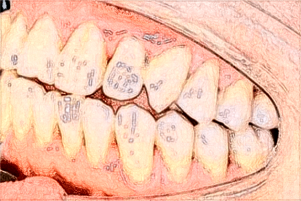 中山大學(xué)附屬口腔醫(yī)院種植牙科怎么樣?種植牙的利與弊
