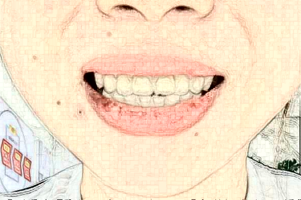 2024綿陽(yáng)市中心醫(yī)院種植牙修復(fù)做的好嗎?誰(shuí)做得好