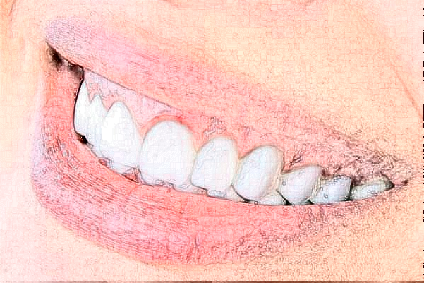 2024無(wú)錫市第一人民醫(yī)院種植牙價(jià)格表發(fā)布_醫(yī)生簡(jiǎn)介+案例