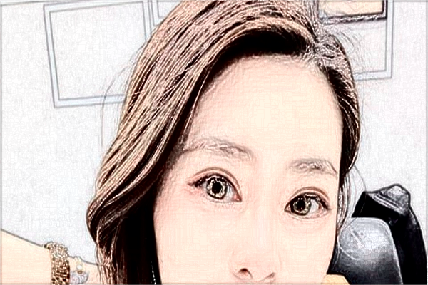 2024無(wú)錫市第一人民醫(yī)院近視激光手術(shù)需要多少錢【案例分享】