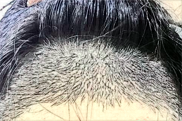 溫州醫(yī)學院附屬第二醫(yī)院植發(fā)價格表_醫(yī)生推薦